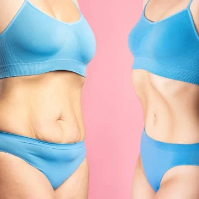 chirurgie_apres_perte_poids