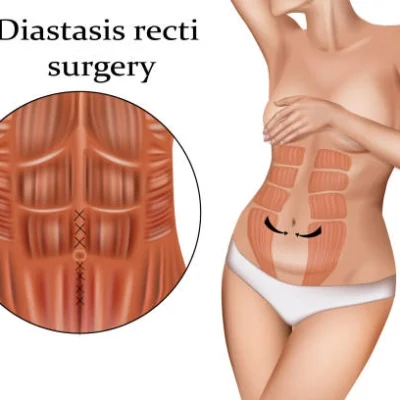 chirurgie_post_partum