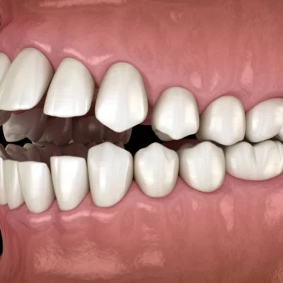 malocclusion_dentaire